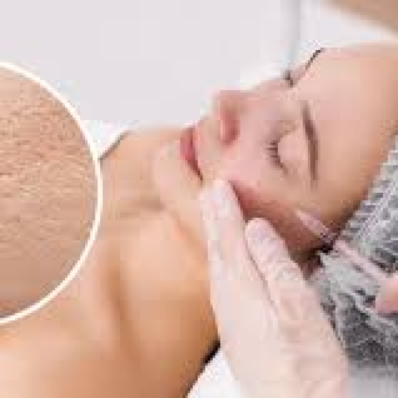 Meso điều trị sẹo lỗ