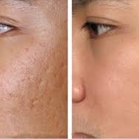 Điều trị sẹo rỗ