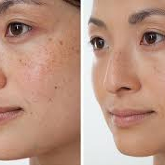 Điều trị tàn nhang