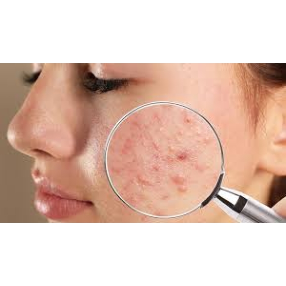 Điều trị mụn